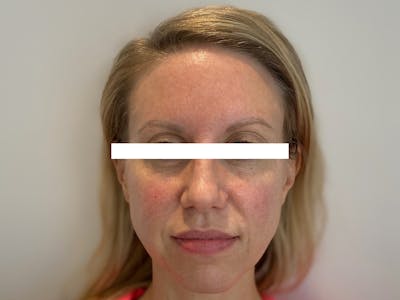 Cheek Filler  Before & After Gallery - Patient 53828952 - Image 1