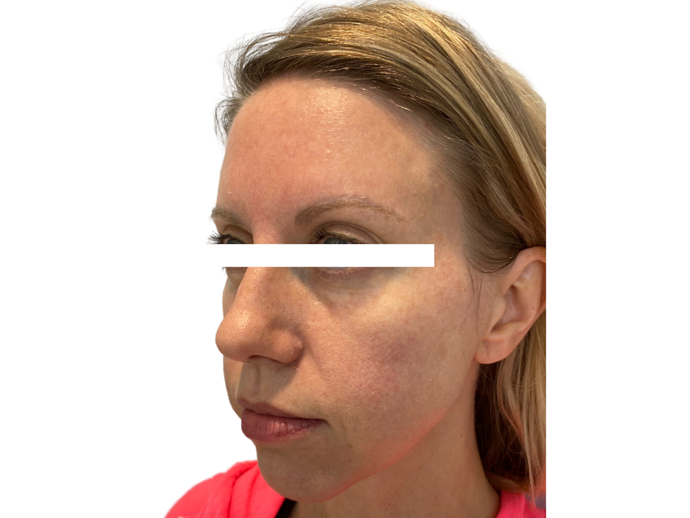 Cheek Filler  Before & After Gallery - Patient 53828952 - Image 3