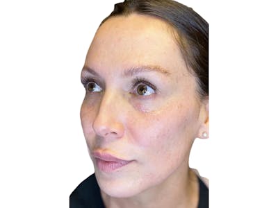 Cheek Filler  Before & After Gallery - Patient 53828953 - Image 1