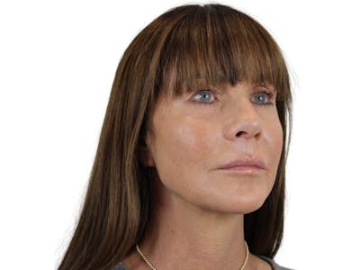 Jawline Filler  Before & After Gallery - Patient 53829933 - Image 2