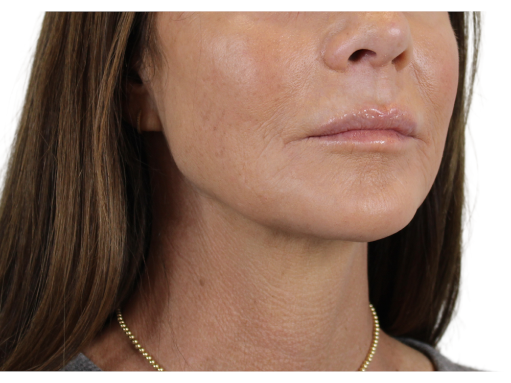 Chin Filler Before & After Gallery - Patient 53829881 - Image 4