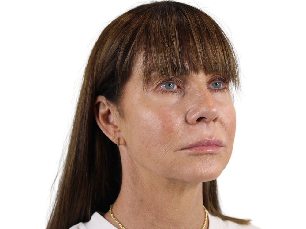 Jawline Filler  Before & After Gallery - Patient 53829933 - Image 1
