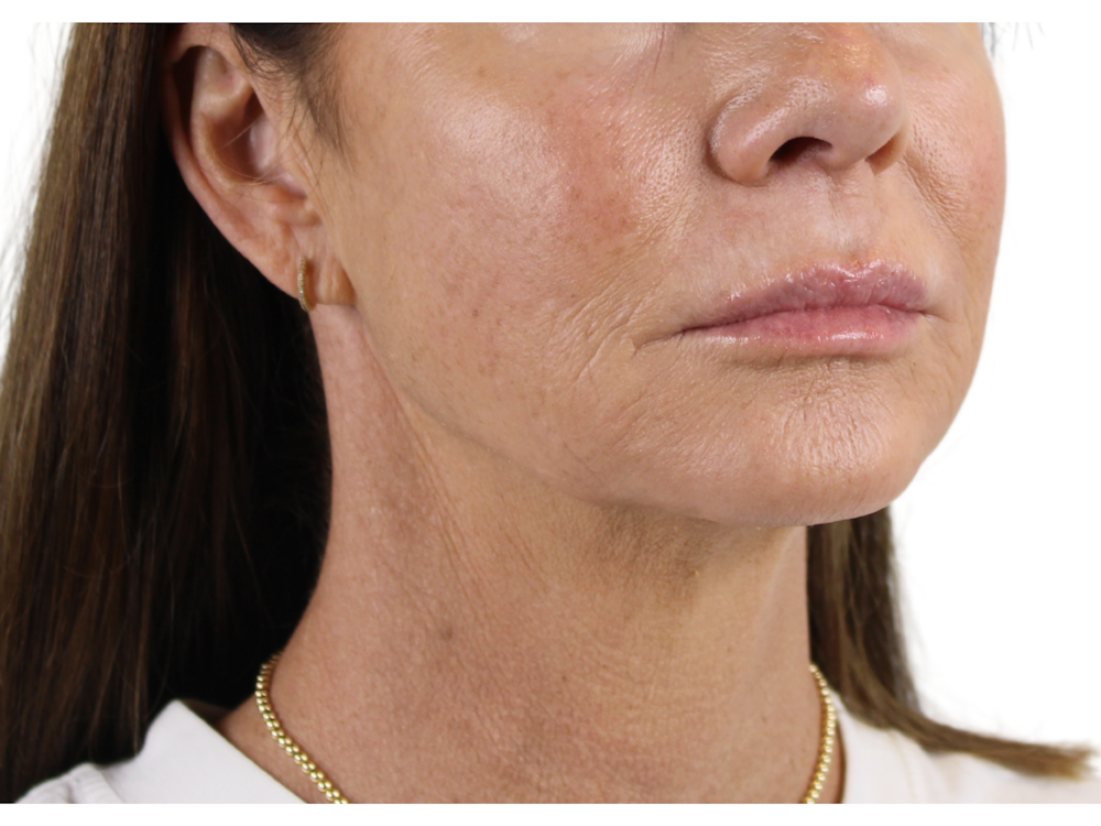Jawline Filler  Before & After Gallery - Patient 53829933 - Image 3