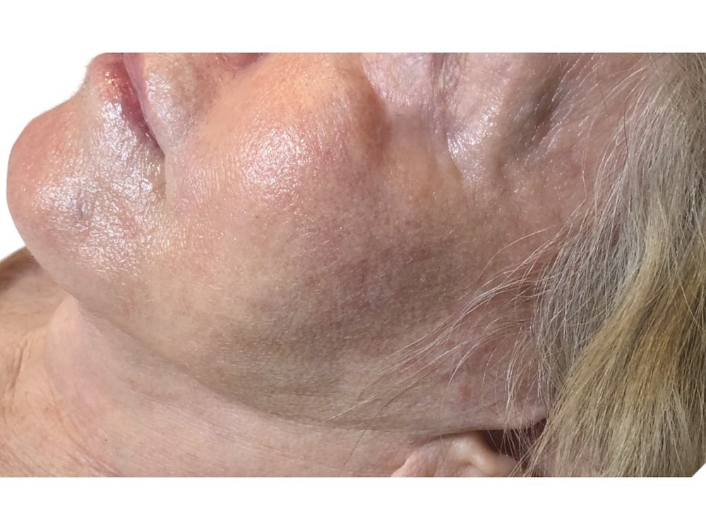 Jawline Filler  Before & After Gallery - Patient 53829934 - Image 1