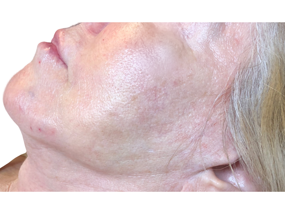 Jawline Filler  Before & After Gallery - Patient 53829934 - Image 2