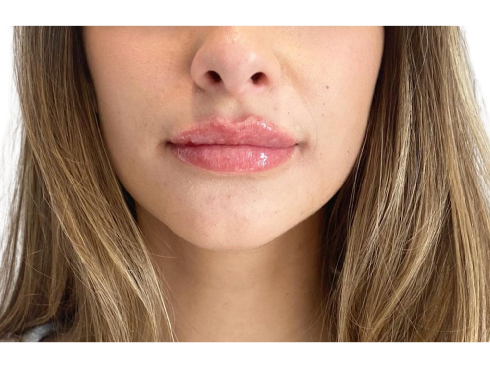 Lip Filler Before & After Gallery - Patient 53830075 - Image 2