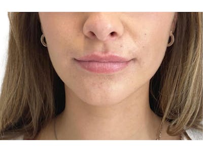 Lip Filler Before & After Gallery - Patient 53830075 - Image 1