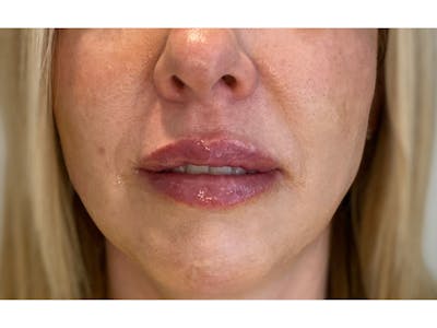 Lip Filler Before & After Gallery - Patient 53830076 - Image 2