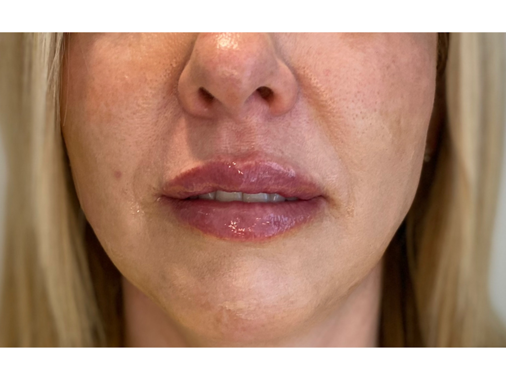 Lip Filler Before & After Gallery - Patient 53830076 - Image 2