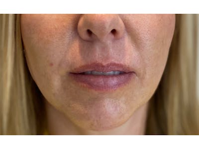 Lip Filler Before & After Gallery - Patient 53830076 - Image 1