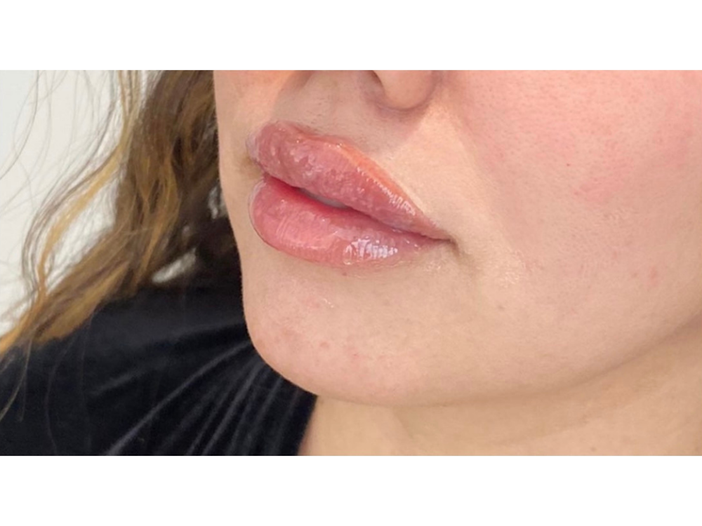 Lip Filler Before & After Gallery - Patient 53830077 - Image 2