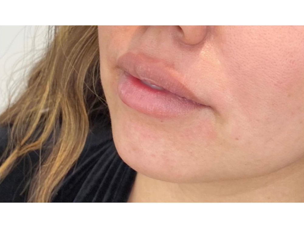 Lip Filler Before & After Gallery - Patient 53830077 - Image 1