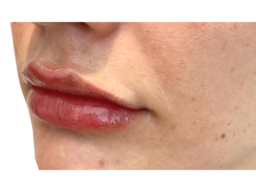 Lip Filler Before & After Gallery - Patient 53830078 - Image 2