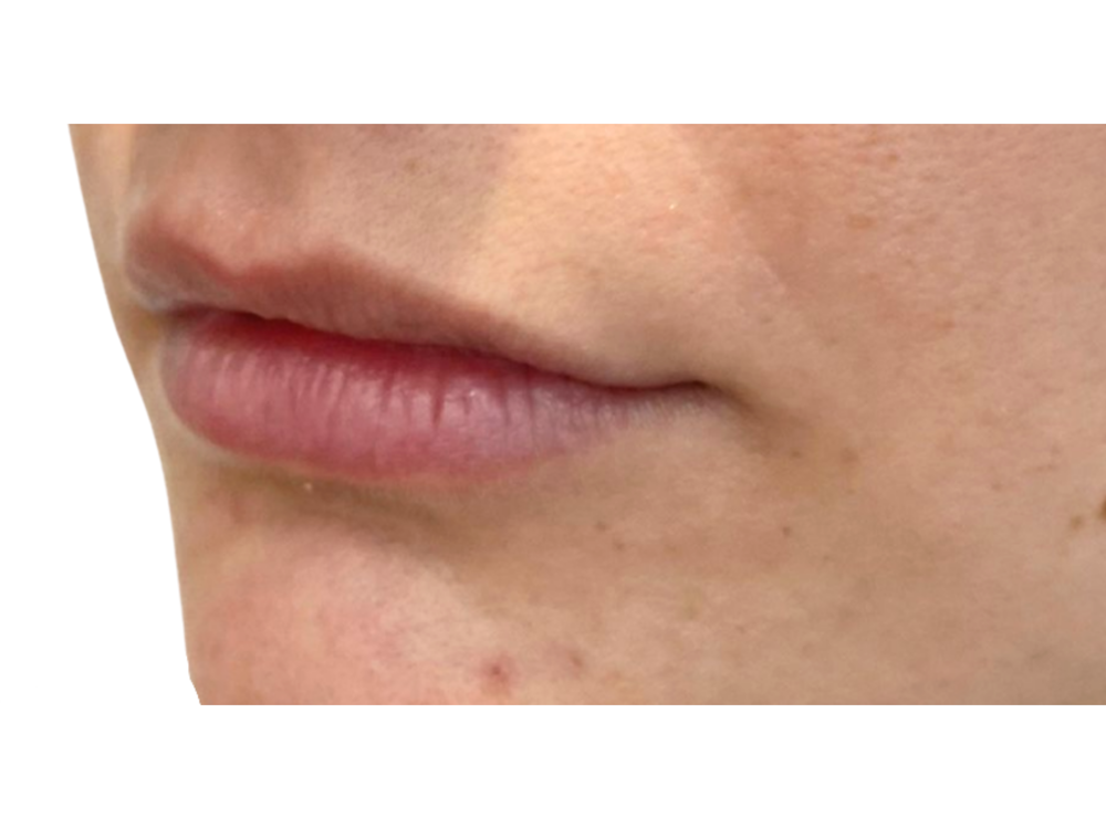 Lip Filler Before & After Gallery - Patient 53830078 - Image 1