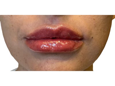 Lip Filler Before & After Gallery - Patient 53830079 - Image 2