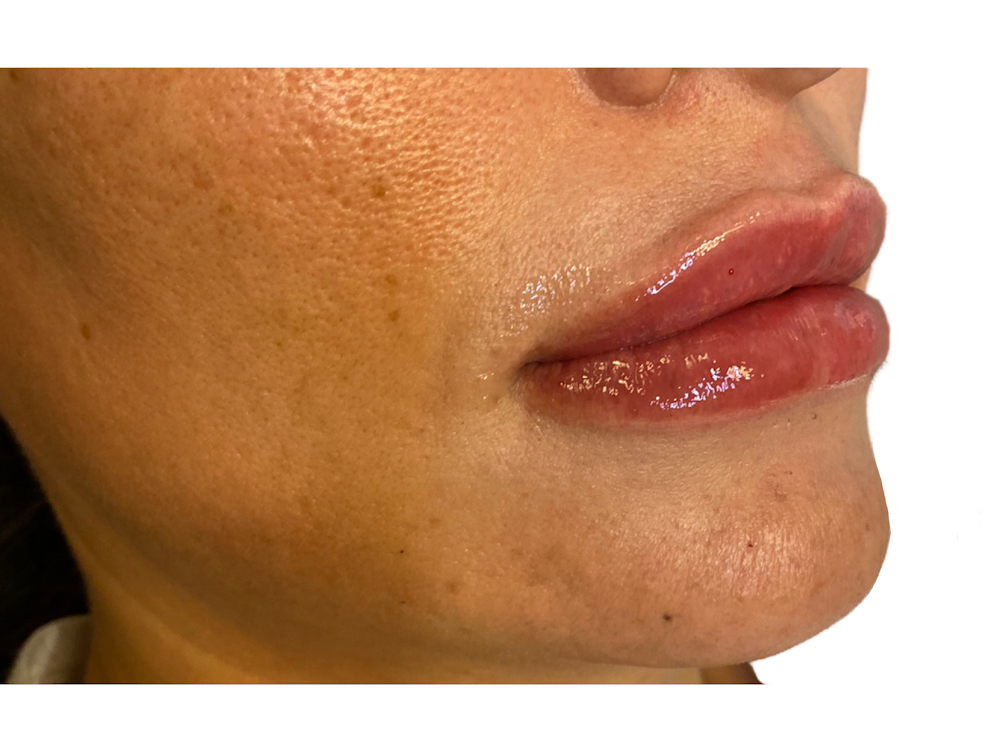 Lip Filler Before & After Gallery - Patient 53830079 - Image 4