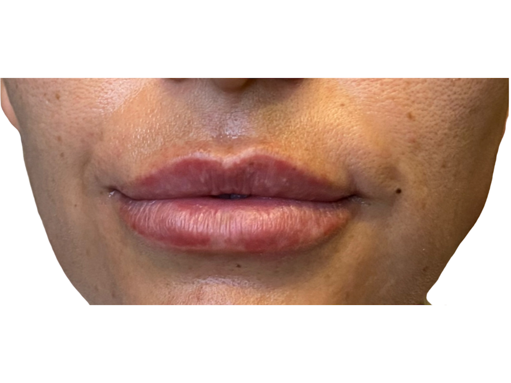 Lip Filler Before & After Gallery - Patient 53830079 - Image 1