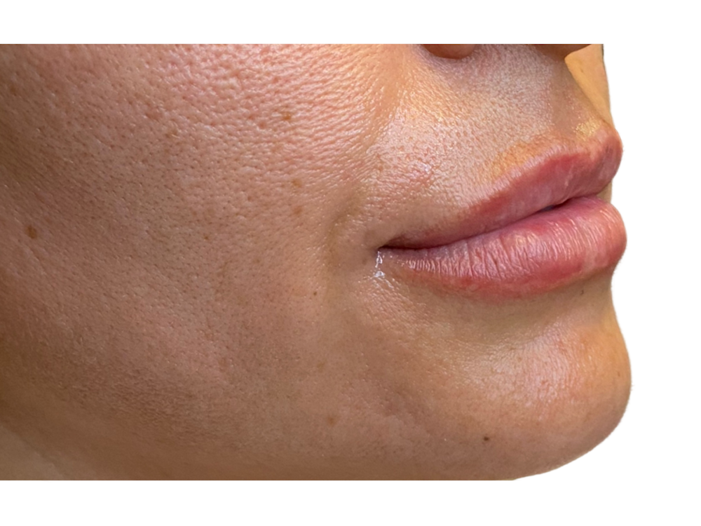 Lip Filler Before & After Gallery - Patient 53830079 - Image 3