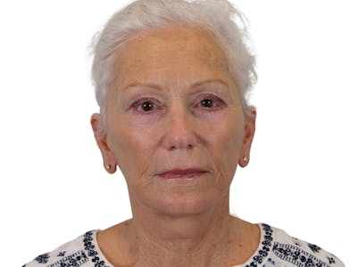 Facelift Before & After Gallery - Patient 57989300 - Image 2