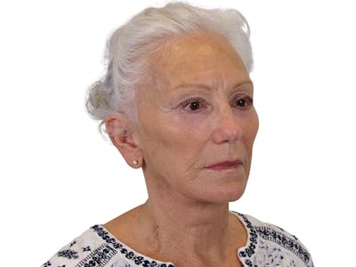 Facelift Before & After Gallery - Patient 57989300 - Image 6