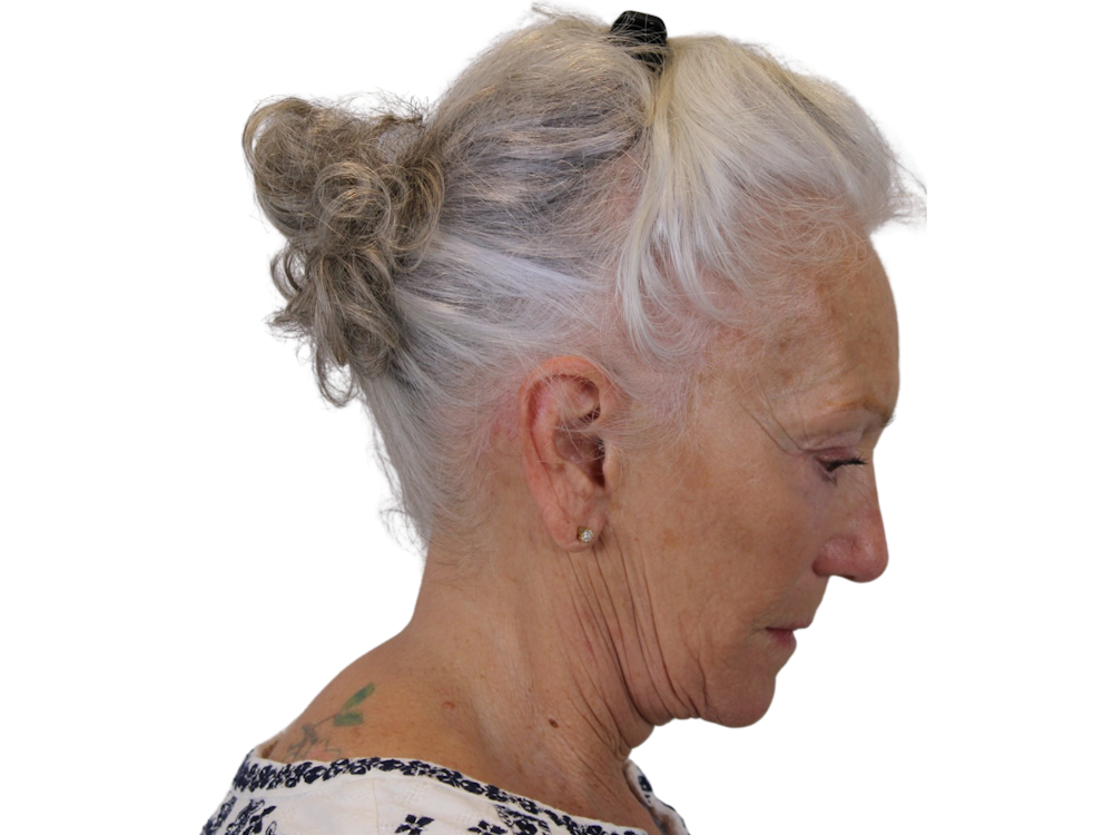 Deep Plane Facelift Before & After Gallery - Patient 57989300 - Image 8