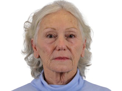 Deep Plane Facelift Before & After Gallery - Patient 57989300 - Image 1