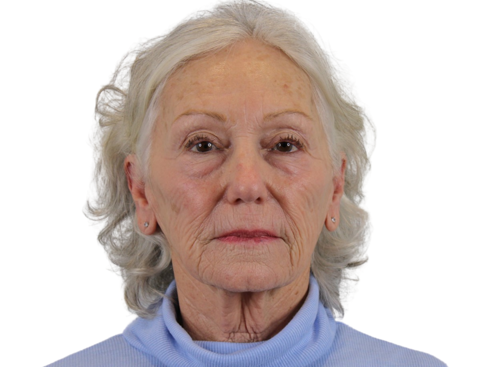 Deep Plane Facelift Before & After Gallery - Patient 57989300 - Image 1
