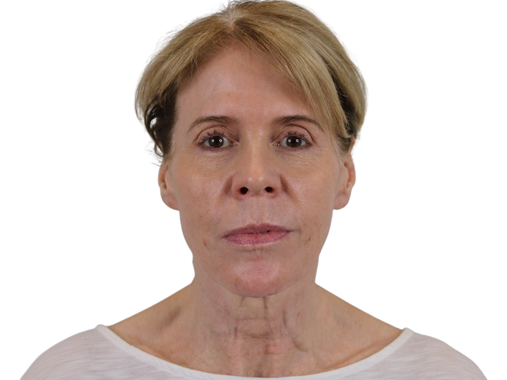 Deep Plane Facelift Before & After Gallery - Patient 50517878 - Image 1