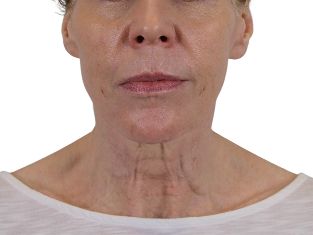 Deep Plane Facelift Before & After Gallery - Patient 50517878 - Image 3