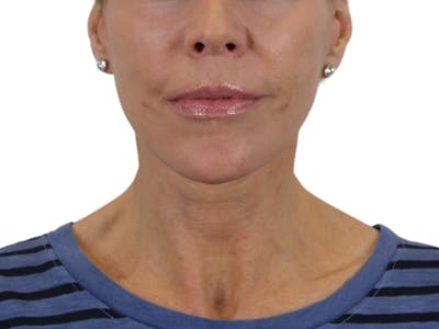 Deep Plane Facelift Before & After Gallery - Patient 50517878 - Image 4