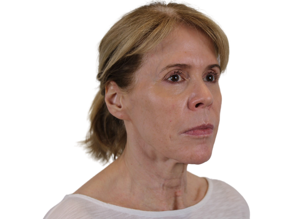 Deep Plane Facelift Before & After Gallery - Patient 50517878 - Image 5