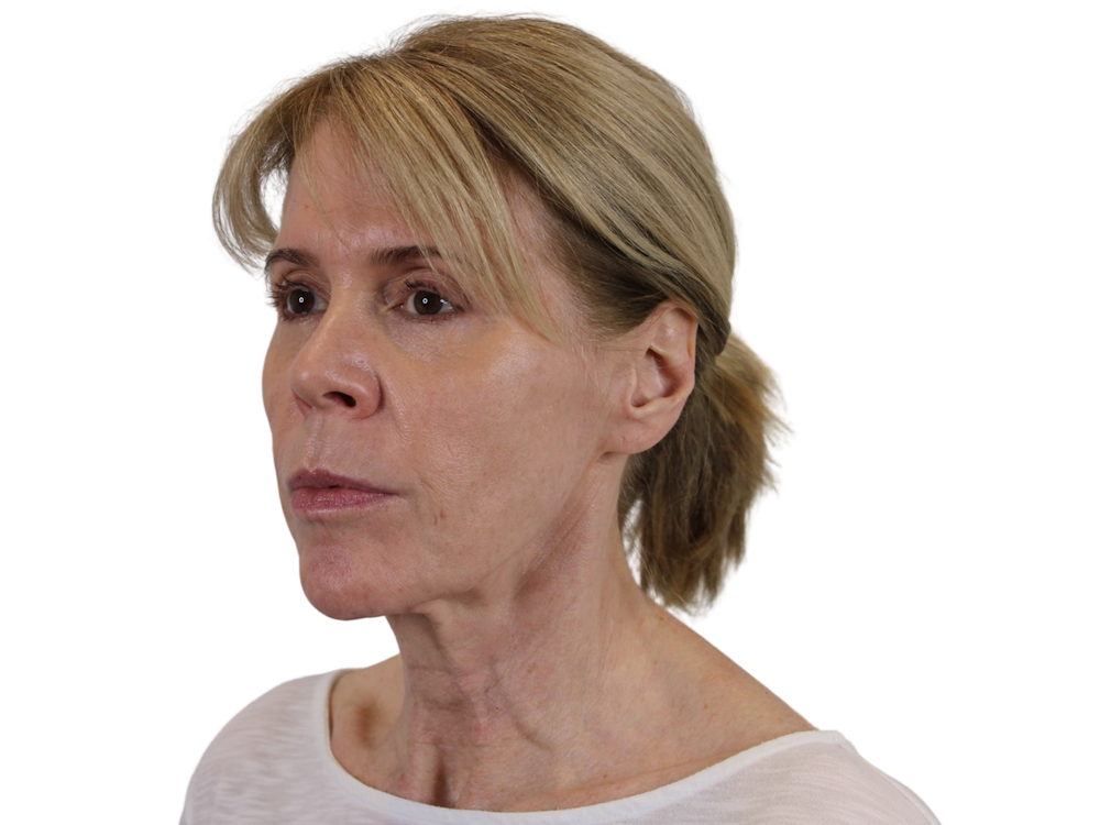 Facelift Before & After Gallery - Patient 50517878 - Image 7