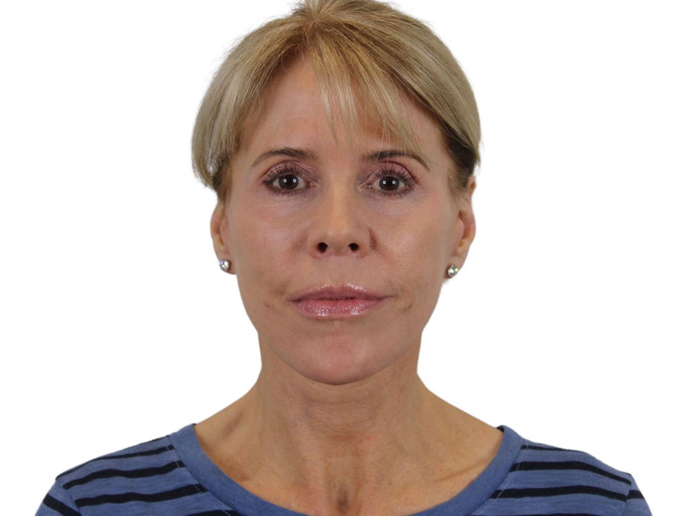 Facelift Before & After Gallery - Patient 50517878 - Image 2