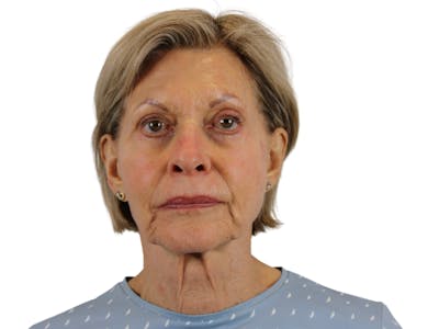 Facelift Before & After Gallery - Patient 50517879 - Image 1