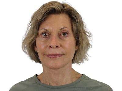 Facelift Before & After Gallery - Patient 50517879 - Image 2