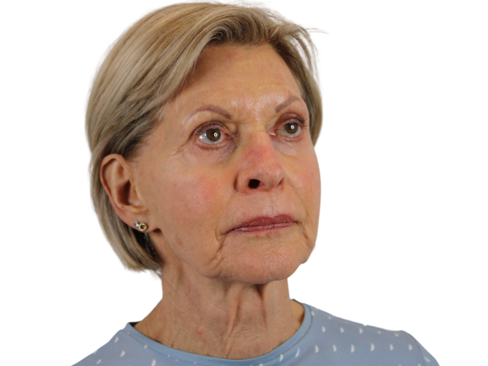 Facelift Before & After Gallery - Patient 50517879 - Image 3
