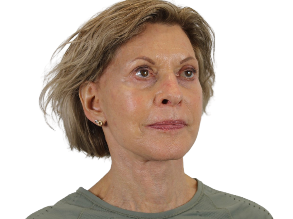 Deep Plane Facelift Before & After Gallery - Patient 50517879 - Image 4