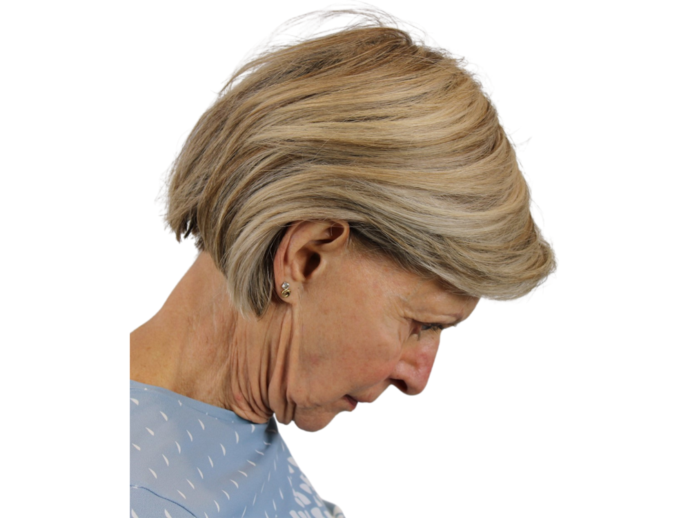Facelift Before & After Gallery - Patient 50517879 - Image 5