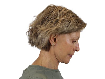 Deep Plane Facelift Before & After Gallery - Patient 50517879 - Image 6