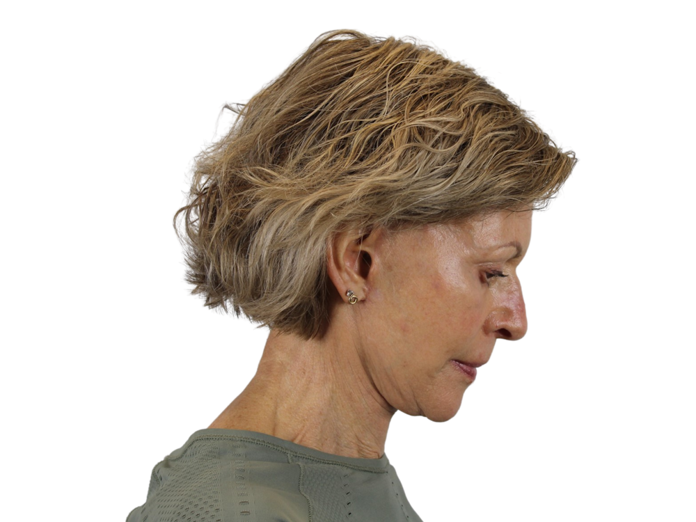 Deep Plane Facelift Before & After Gallery - Patient 50517879 - Image 6