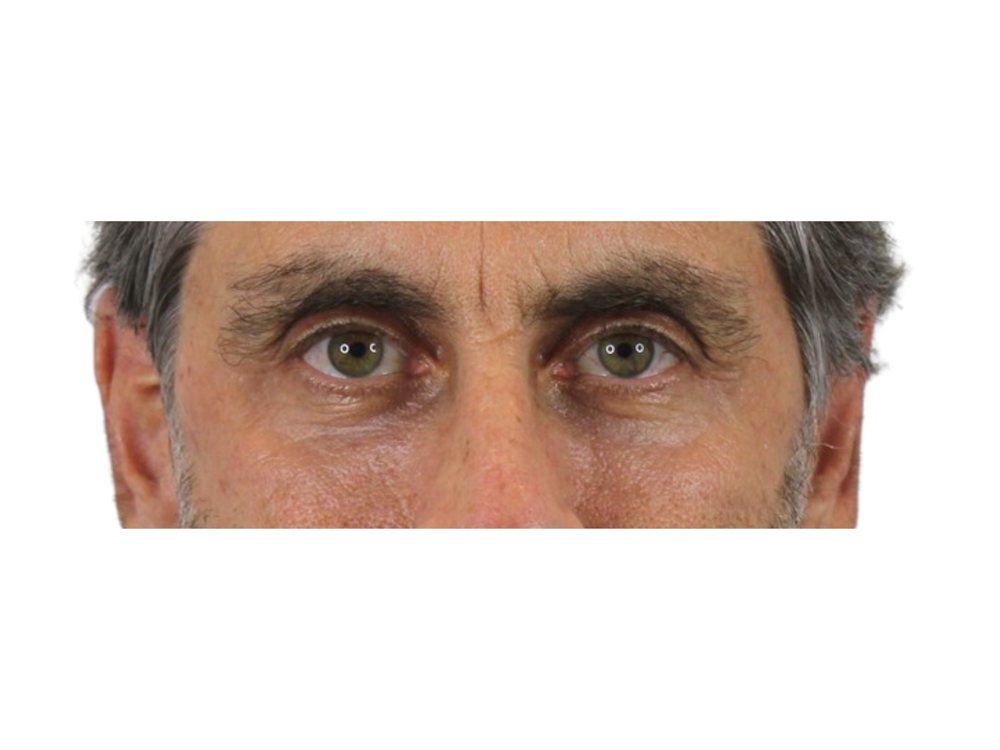 Blepharoplasty Before & After Gallery - Patient 53828309 - Image 8