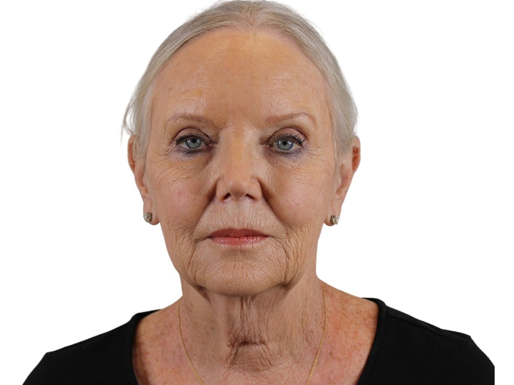 Deep Plane Facelift Before & After Gallery - Patient 59893859 - Image 1