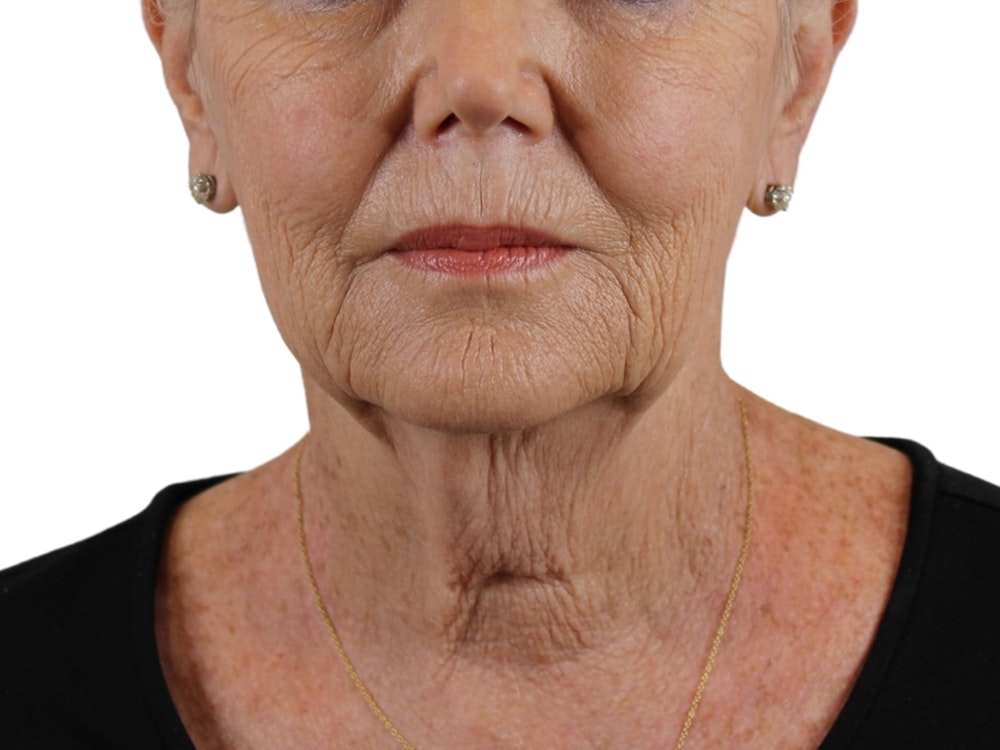 Deep Plane Facelift Before & After Gallery - Patient 59893859 - Image 3