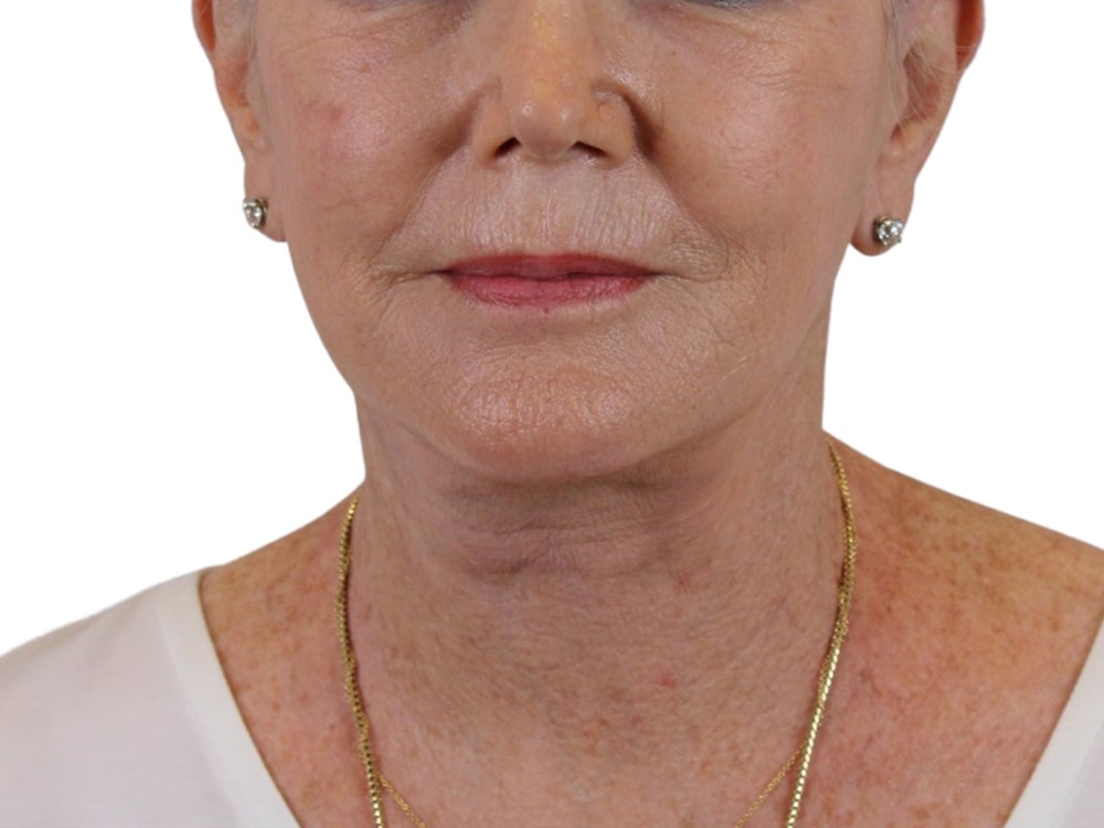 Deep Plane Facelift Before & After Gallery - Patient 59893859 - Image 4