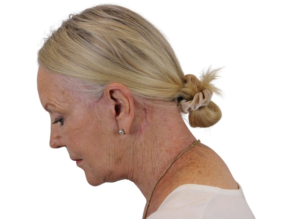 Deep Plane Facelift Before & After Gallery - Patient 59893859 - Image 6