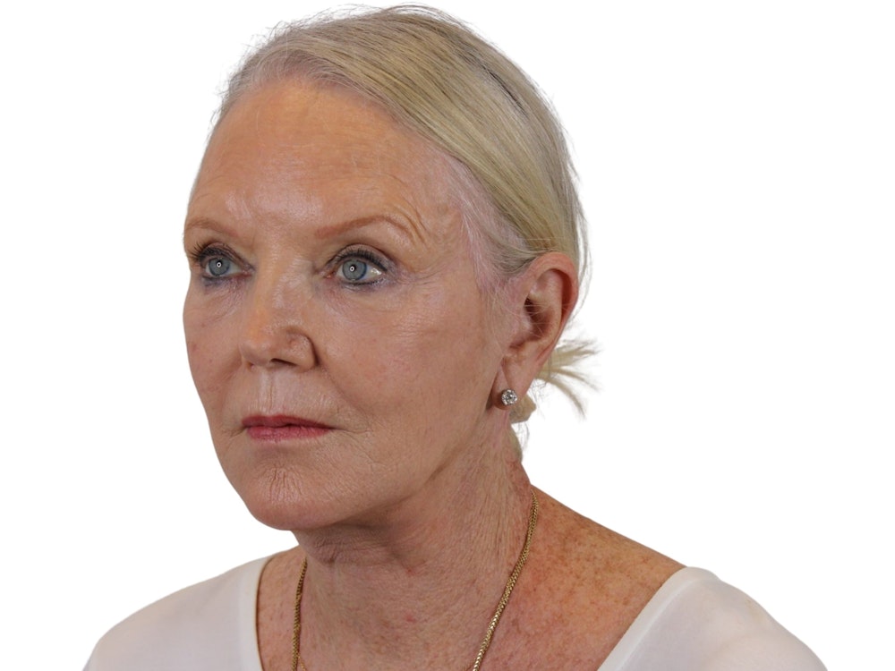 Deep Plane Facelift Before & After Gallery - Patient 59893859 - Image 8
