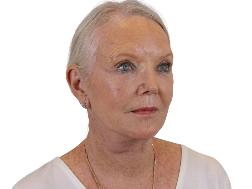 Deep Plane Facelift Before & After Gallery - Patient 59893859 - Image 10
