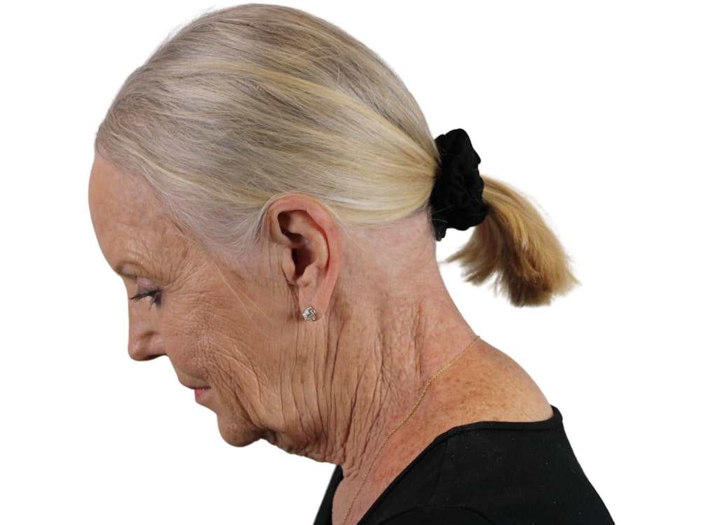 Deep Plane Facelift Before & After Gallery - Patient 59893859 - Image 5