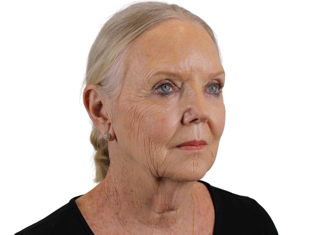 Deep Plane Facelift Before & After Gallery - Patient 59893859 - Image 9