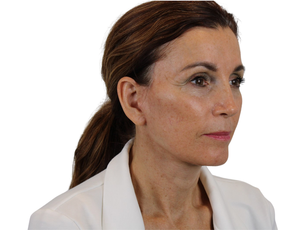 Deep Plane Facelift Before & After Gallery - Patient 59893925 - Image 8